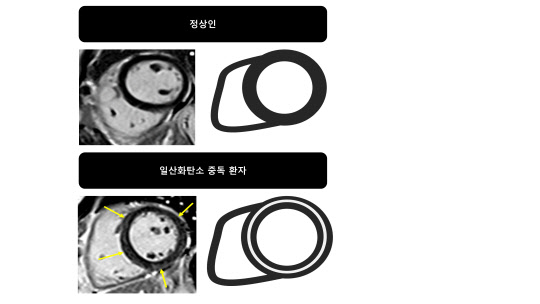 일산화탄소 중독 환자를 심장자기공명영상으로 촬영한 심근 손상 모습으로, 104명의 환자 중 69%의 환자에서 관찰됐다. 104명 중 40% 환자에서는 심근의 중간벽층에 섬유화 현상도 보였다. 연구재단 제공